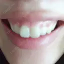 ガミースマイル手術 有楽町美容外科クリニック DAY 2 サムネイル用
