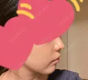 小鼻縮小（切開） / 鼻翼基部形成（貴族手術） 新宿ラクル美容外科クリニック 新宿院 DAY 64 サムネイル用