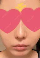 小鼻縮小（切開） / 鼻翼基部形成（貴族手術） 新宿ラクル美容外科クリニック 新宿院 DAY 64 サムネイル用