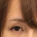 二重切開 高須クリニック 名古屋院 AFTER サムネイル用