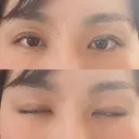 二重切開 郡山タウン形成外科クリニック DAY 36 サムネイル用