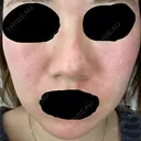 ピーリング（ニキビ・毛穴） / ダーマペン Zetith Beauty Clinic 銀座院 DAY 0 サムネイル用