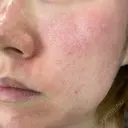 ピーリング（ニキビ・毛穴） / ダーマペン Zetith Beauty Clinic 銀座院 DAY 0 サムネイル用