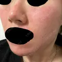 ピーリング（ニキビ・毛穴） / ダーマペン Zetith Beauty Clinic 銀座院 DAY 1 サムネイル用