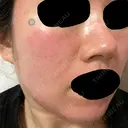 ピーリング（ニキビ・毛穴） / ダーマペン Zetith Beauty Clinic 銀座院 DAY 1 サムネイル用