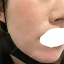 ピーリング（ニキビ・毛穴） / ダーマペン Zetith Beauty Clinic 銀座院 DAY 2 サムネイル用