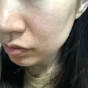 ダーマペン えいご皮フ科 奈良院 DAY 8 サムネイル用