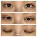 二重埋没 湘南美容クリニック 藤沢院 DAY 9 サムネイル用