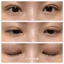 二重埋没 湘南美容クリニック 藤沢院 DAY 11 サムネイル用