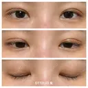 二重埋没 湘南美容クリニック 藤沢院 DAY 12 サムネイル用