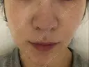 糸リフト ノーチェビューティクリニック AFTER サムネイル用
