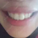 ガミースマイル手術 有楽町美容外科クリニック DAY 3 サムネイル用