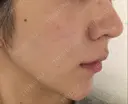 糸リフト ノーチェビューティクリニック DAY 31 サムネイル用