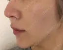 糸リフト ノーチェビューティクリニック DAY 31 サムネイル用
