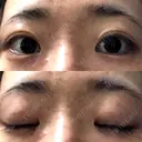 二重埋没 共立美容外科 神戸三宮院 DAY 14 サムネイル用