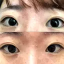 二重埋没 共立美容外科 神戸三宮院 DAY 101 サムネイル用