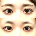 目頭切開 聖心美容クリニック 横浜院 DAY 18 サムネイル用