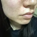 ダーマペン えいご皮フ科 奈良院 DAY 11 サムネイル用