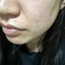 ダーマペン えいご皮フ科 奈良院 DAY 11 サムネイル用