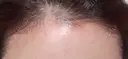 アートメイク（ヘアライン） トイトイトイクリニック 池袋院 AFTER サムネイル用