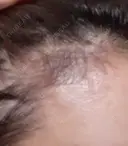 アートメイク（ヘアライン） トイトイトイクリニック 池袋院 DAY 68 サムネイル用