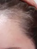 アートメイク（ヘアライン） トイトイトイクリニック 池袋院 DAY 68 サムネイル用