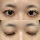 目頭切開 聖心美容クリニック 横浜院 DAY 19 サムネイル用