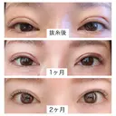 二重切開 北尾クリニック DAY 59 サムネイル用