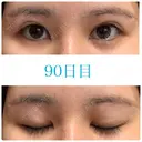 上まぶたの脂肪取り / 眉下切開 JUN CLINIC DAY 90 サムネイル用