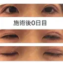 二重埋没 高須クリニック 大阪院 DAY 0 サムネイル用