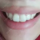 ガミースマイル手術 有楽町美容外科クリニック DAY 4 サムネイル用