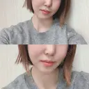 骨切り（あご） / 骨削り（エラ） / 骨削り（頬） id（アイディ）美容外科 DAY 336 サムネイル用