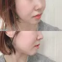 骨切り（あご） / 骨削り（エラ） / 骨削り（頬） id（アイディ）美容外科 DAY 336 サムネイル用