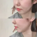 骨切り（あご） / 骨削り（エラ） / 骨削り（頬） id（アイディ）美容外科 DAY 336 サムネイル用