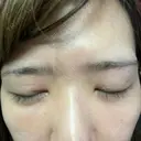 二重埋没 / 下まぶたの脂肪取り 品川美容外科 福岡院 DAY 11 サムネイル用