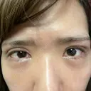 二重埋没 / 下まぶたの脂肪取り 品川美容外科 福岡院 DAY 11 サムネイル用
