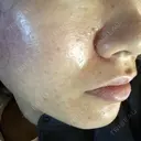 ダーマペン えいご皮フ科 奈良院 DAY 15 サムネイル用