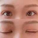 二重切開 EMMA CLINIC（エマクリニック） DAY 36 サムネイル用