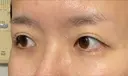 ヒアルロン酸注入（涙袋） 新宿ビューティークリニック 新宿院 DAY 9 サムネイル用