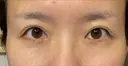 ヒアルロン酸注入（涙袋） 新宿ビューティークリニック 新宿院 DAY 9 サムネイル用