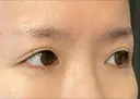 ヒアルロン酸注入（涙袋） 新宿ビューティークリニック 新宿院 DAY 10 サムネイル用