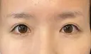 ヒアルロン酸注入（涙袋） 新宿ビューティークリニック 新宿院 DAY 10 サムネイル用