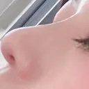 ヒアルロン酸注入（鼻） 白山クリニック 大分 DAY 1 サムネイル用