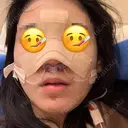 鼻尖形成（切開） / 鼻中隔延長（切開） / 軟骨移植 / その他（鼻） KAUNIS CLINIC（カウニスクリニック） DAY 0 サムネイル用