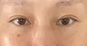 下まぶたたるみ取り / 下まぶたの脂肪取り ヨーダー公子クリニック眼科・美容皮膚科 横浜六浦院 AFTER サムネイル用