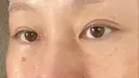 下まぶたたるみ取り / 下まぶたの脂肪取り ヨーダー公子クリニック眼科・美容皮膚科 横浜六浦院 DAY 90 サムネイル用