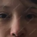 二重切開 / 隆鼻術 / 鼻中隔延長（切開） 牧野皮膚科形成外科内科医院 美容外科・形成外科・抗加齢医学外来 DAY 74 サムネイル用