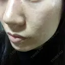 ダーマペン えいご皮フ科 奈良院 DAY 17 サムネイル用