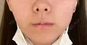 脂肪吸引（顔） Mods Clinic（モッズクリニック） 東京院 DAY 6 サムネイル用