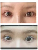 目尻切開 / タレ目形成・グラマラスライン（切開） ビスポーククリニック 福岡院 DAY 21 サムネイル用